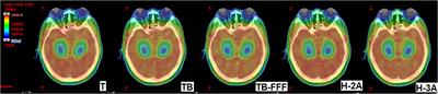 Volumetric modulated arc therapy for hippocampal-sparing prophylactic cranial irradiation: Planning comparison of Halcyon and C-arm accelerators